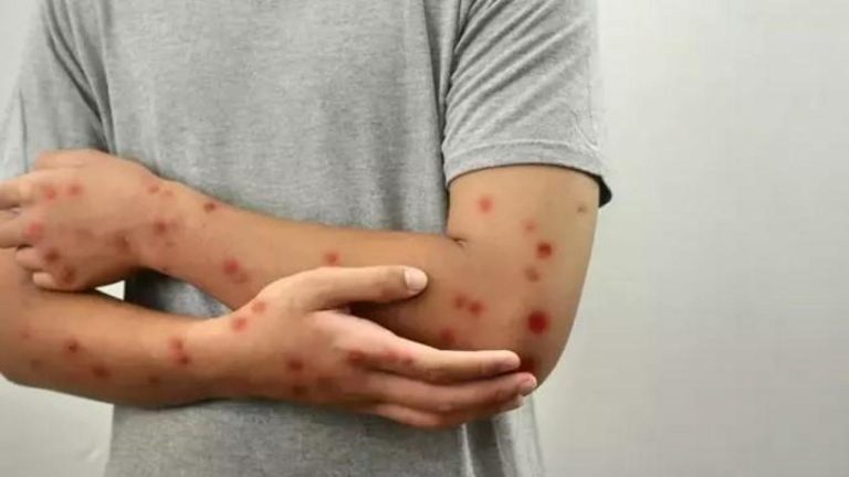 Çocuklarda bu tür döküntüler varsa dikkatli olun! Uzmanlar uyarıyor: Okullarda hızla yayılıyor