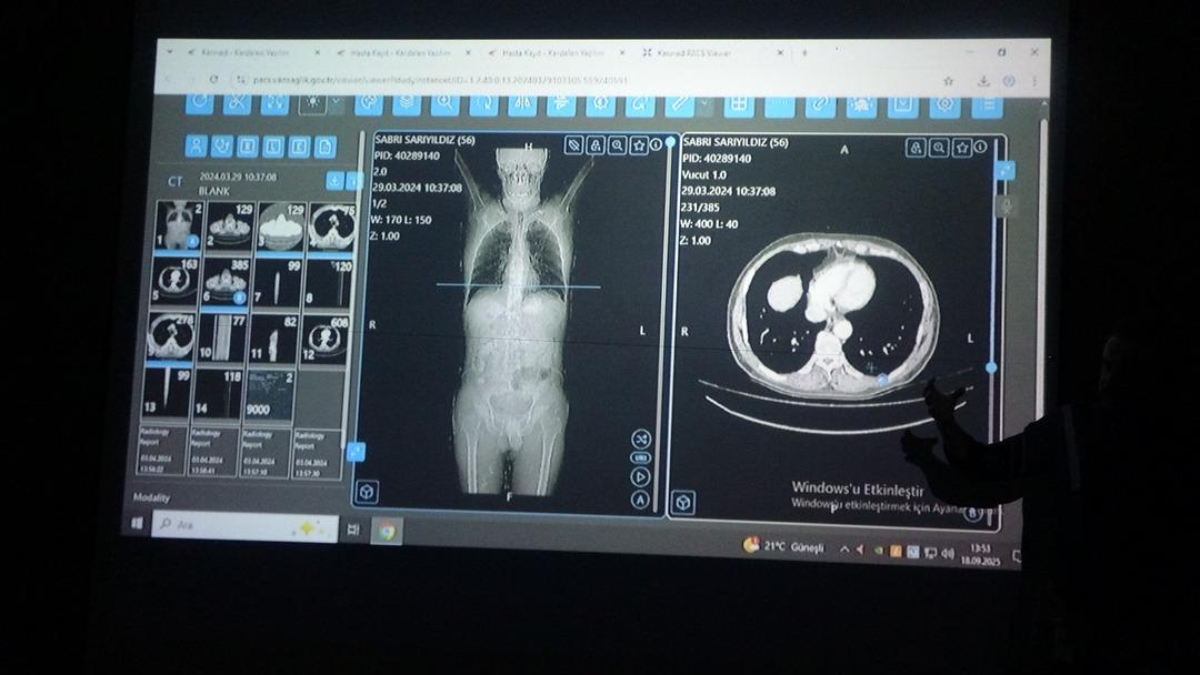 Dünya için bir örnekti! Türkiye'de bir ilk: Kanser tedavisinde yapay zeka kullanıldı 4