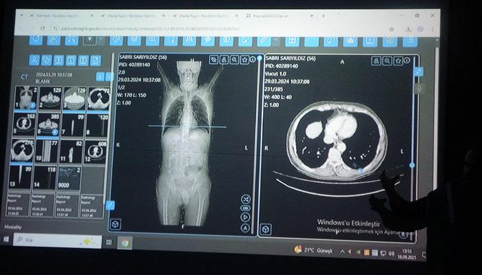Dünyaya örnek oldu! Türkiye’de bir ilk: Kanser tedavisinde yapay zeka kullanıldı