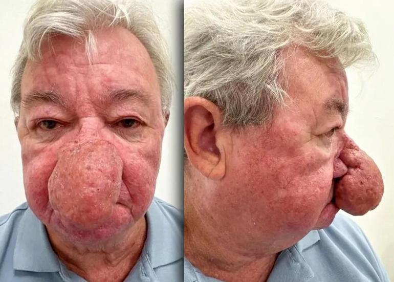 Burnu giderek büyüdü. 68 yaşındaki adam kabus gördü ve 4 saatlik operasyonla adeta yeniden doğdu.